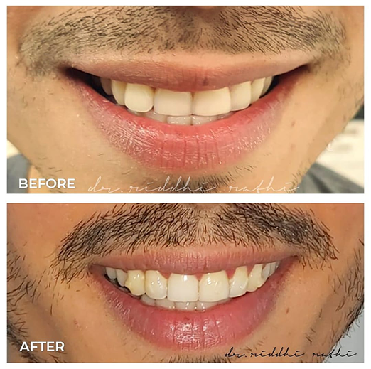 Teeth transformation