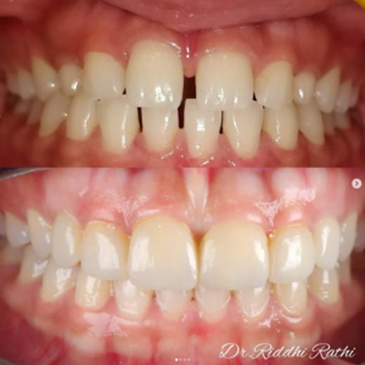 Teeth transformation
