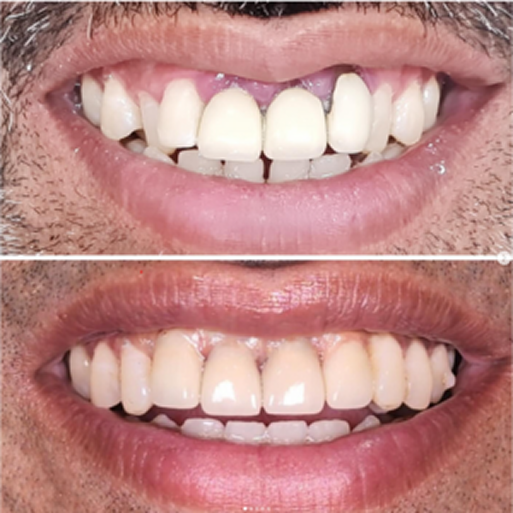Teeth transformation