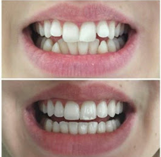 Teeth transformation