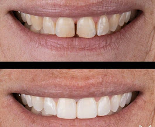 Teeth transformation